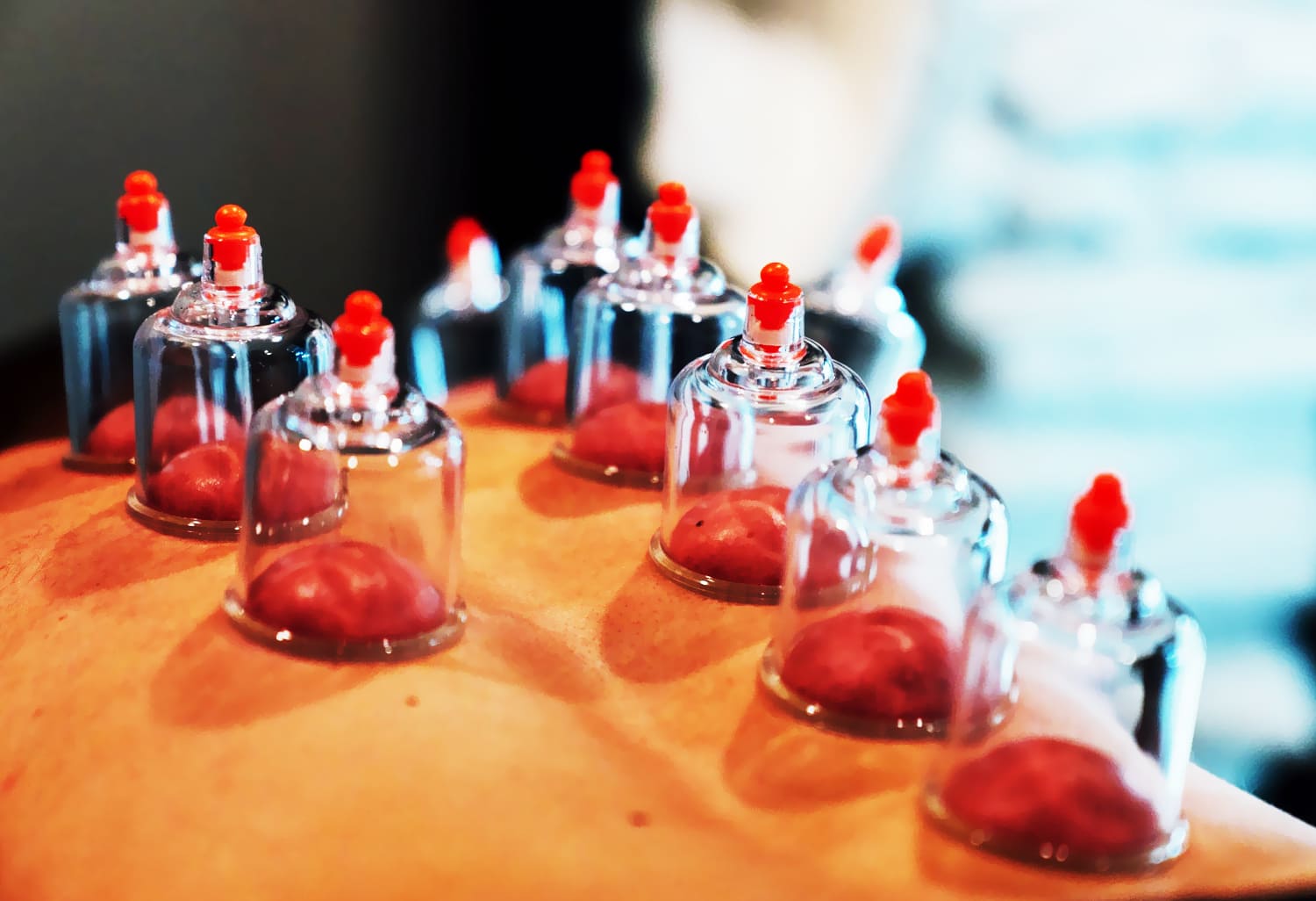 The Relationship between Wet Cupping Therapy and Ruqyah with Patients Psychological Conditions from a Spiritual Perspective